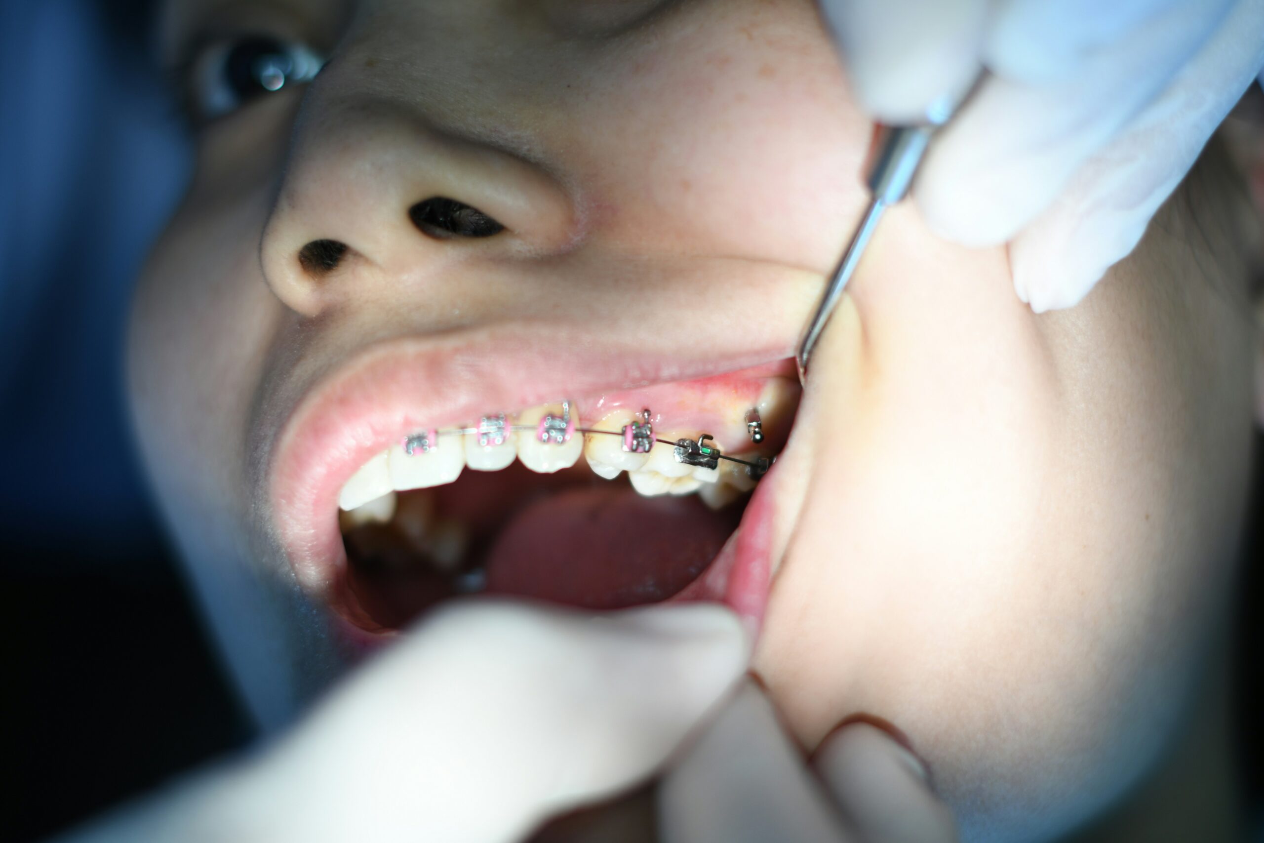 Best Braces Treatment in Hyderabad